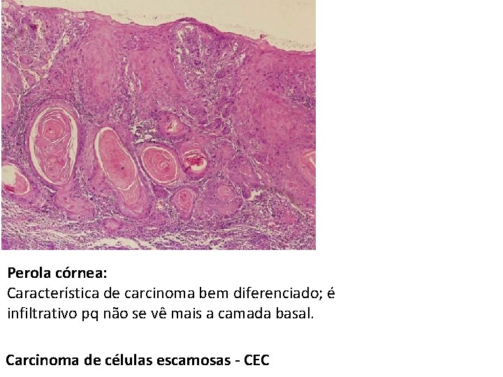 Perola córnea: Característica de carcinoma bem diferenciado; é infiltrativo pq não se vê mais