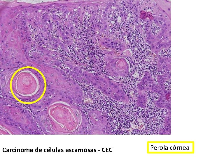 Carcinoma de células escamosas - CEC Perola córnea 