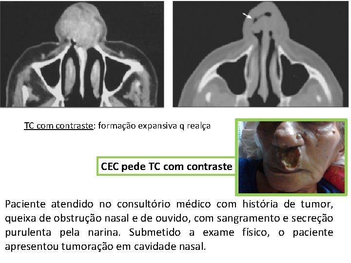 TC com contraste: formação expansiva q realça CEC pede TC com contraste Paciente atendido