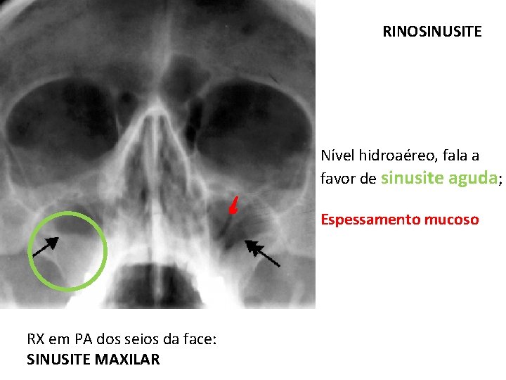 RINOSINUSITE Nível hidroaéreo, fala a favor de sinusite aguda; Espessamento mucoso RX em PA