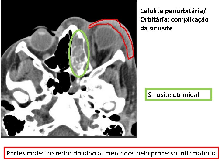 Celulite periorbitária/ Orbitária: complicação da sinusite Sinusite etmoidal Partes moles ao redor do olho