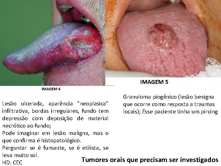 Granuloma piogênico (lesão benigna que ocorre como resposta a traumas locais); Esse paciente tinha