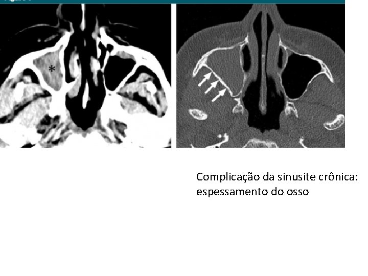 Complicação da sinusite crônica: espessamento do osso 
