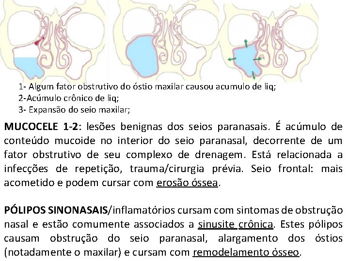 1 - Algum fator obstrutivo do óstio maxilar causou acumulo de liq; 2 -Acúmulo