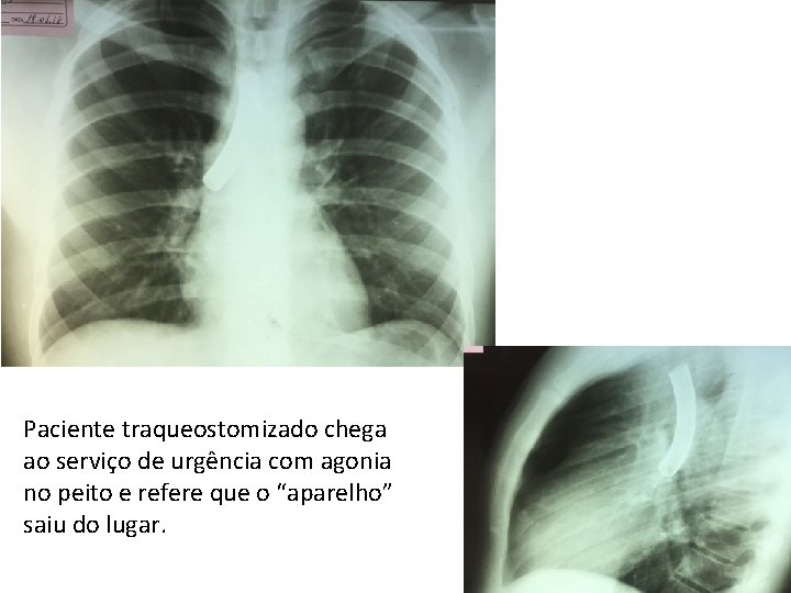 Paciente traqueostomizado chega ao serviço de urgência com agonia no peito e refere que