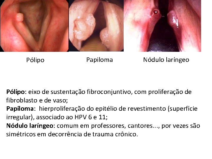 Pólipo Papiloma Nódulo laríngeo Pólipo: eixo de sustentação fibroconjuntivo, com proliferação de fibroblasto e