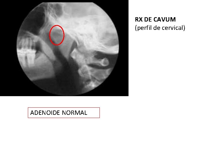 RX DE CAVUM (perfil de cervical) ADENOIDE NORMAL 