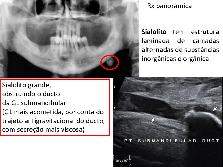 Rx panorâmica Sialolito tem estrutura laminada de camadas alternadas de substâncias inorgânicas e orgânica