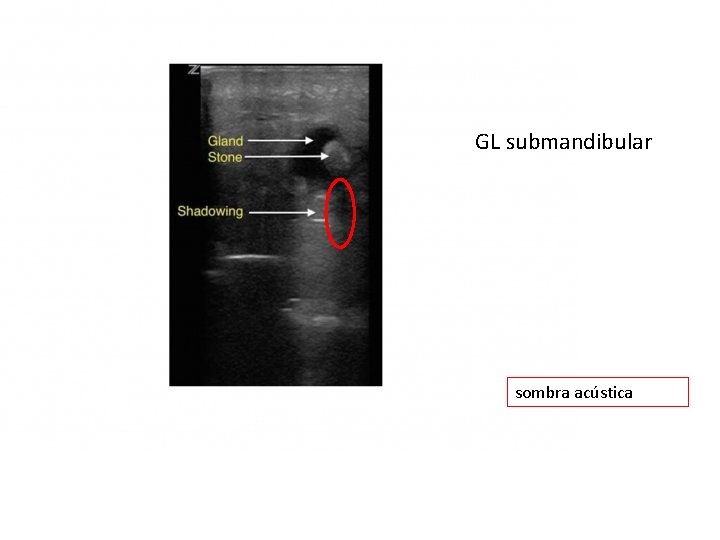 GL submandibular sombra acústica 