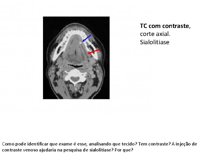 TC com contraste, corte axial. Sialolitiase Como pode identificar que exame é esse, analisando