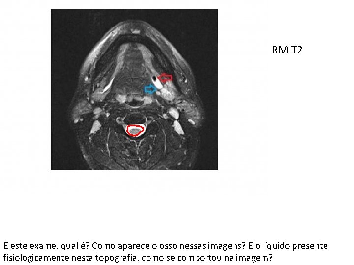 RM T 2 E este exame, qual é? Como aparece o osso nessas imagens?