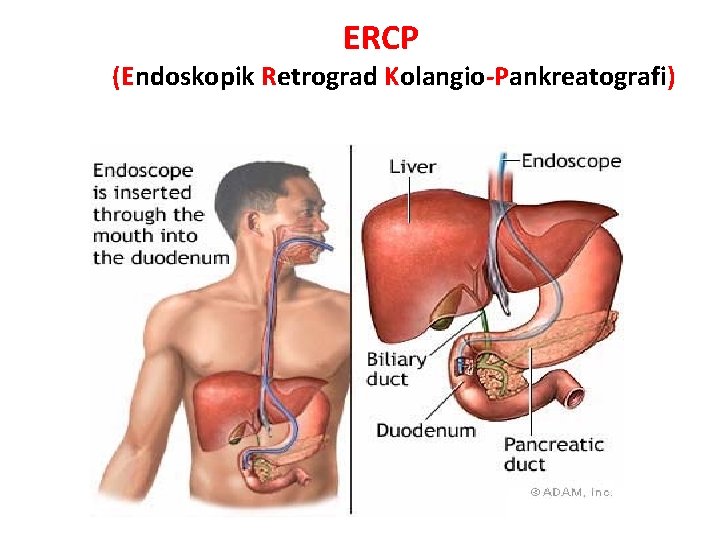 ERCP (Endoskopik Retrograd Kolangio-Pankreatografi) 