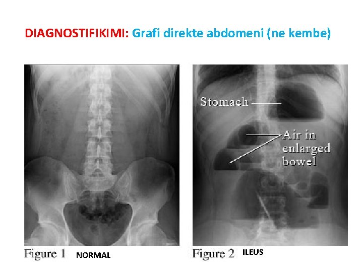 DIAGNOSTIFIKIMI: Grafi direkte abdomeni (ne kembe) NORMAL ILEUS 