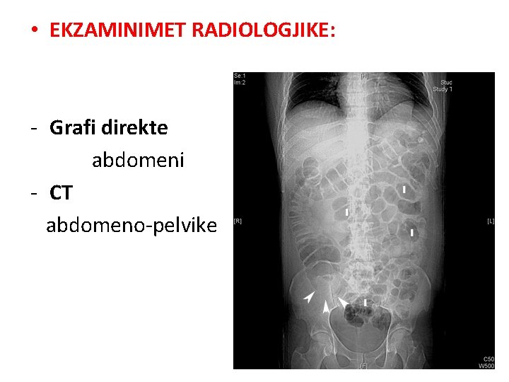  • EKZAMINIMET RADIOLOGJIKE: - Grafi direkte abdomeni - CT abdomeno-pelvike 