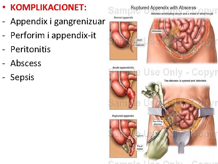  • - KOMPLIKACIONET: Appendix i gangrenizuar Perforim i appendix-it Peritonitis Abscess Sepsis 
