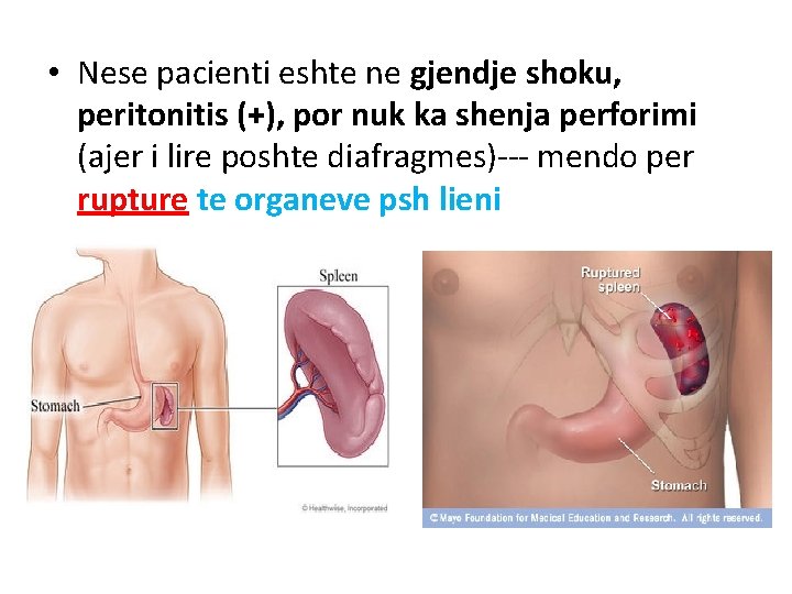  • Nese pacienti eshte ne gjendje shoku, peritonitis (+), por nuk ka shenja