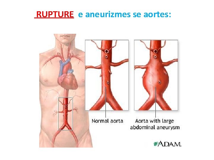 RUPTURE e aneurizmes se aortes: 