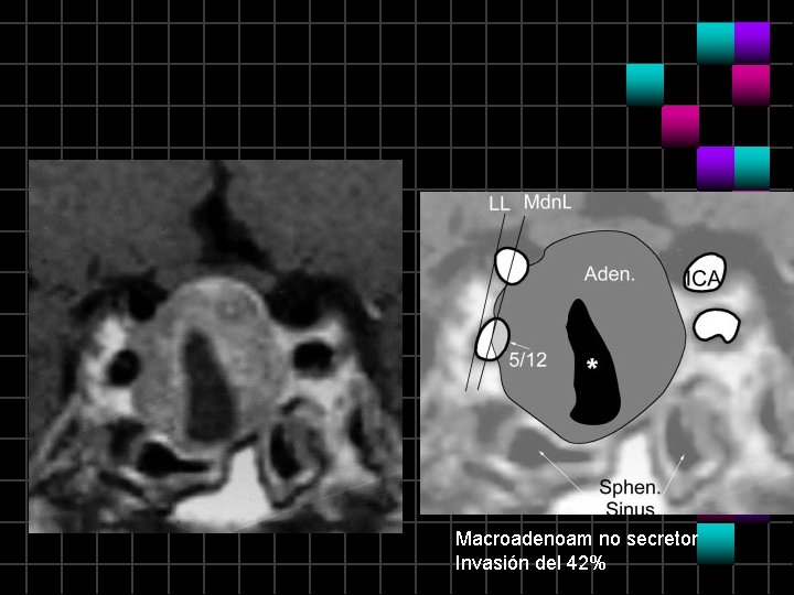 Macroadenoam no secretor Invasión del 42% 