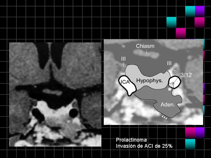 Prolactinoma Invasión de ACI de 25% 