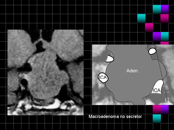 Macroadenoma no secretor 