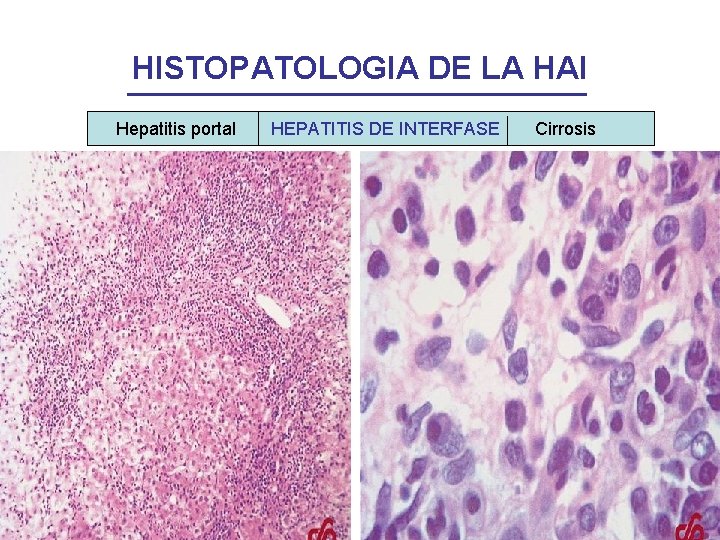 HISTOPATOLOGIA DE LA HAI Hepatitis portal HEPATITIS DE INTERFASE Cirrosis 