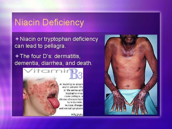 Niacin Deficiency Niacin or tryptophan deficiency can lead to pellagra. The four D’s: dermatitis,