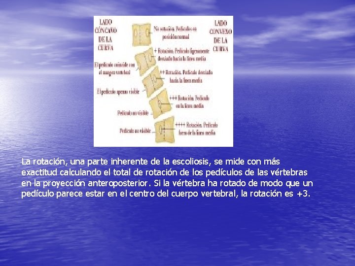 La rotación, una parte inherente de la escoliosis, se mide con más exactitud calculando