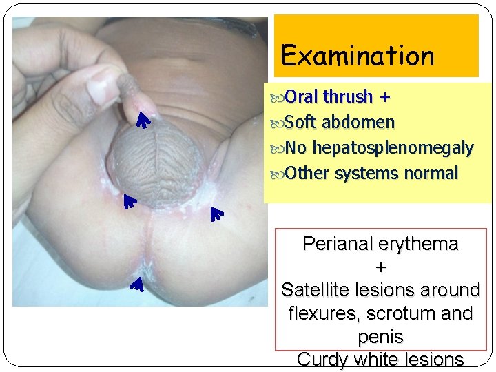 Examination Oral thrush + Soft abdomen No hepatosplenomegaly Other systems normal Perianal erythema +