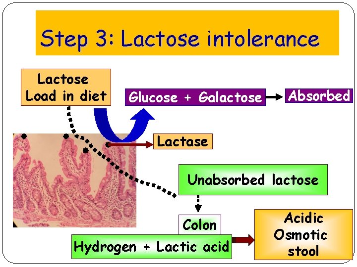 Step 3: Lactose intolerance Lactose Load in diet Glucose + Galactose Absorbed Lactase Unabsorbed