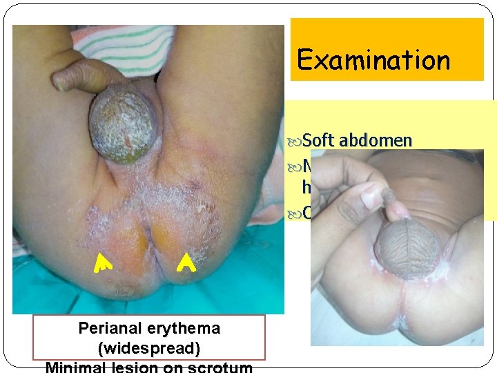 Examination Soft abdomen No hepatosplenomegaly Other systems normal Perianal erythema (widespread) 