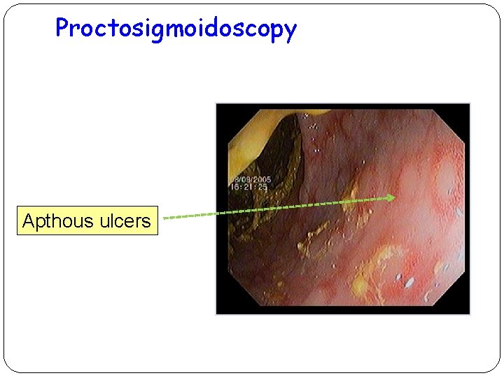 Proctosigmoidoscopy Apthous ulcers 