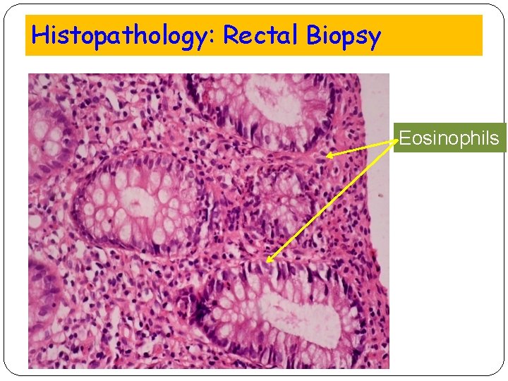 Histopathology: Rectal Biopsy Eosinophils 