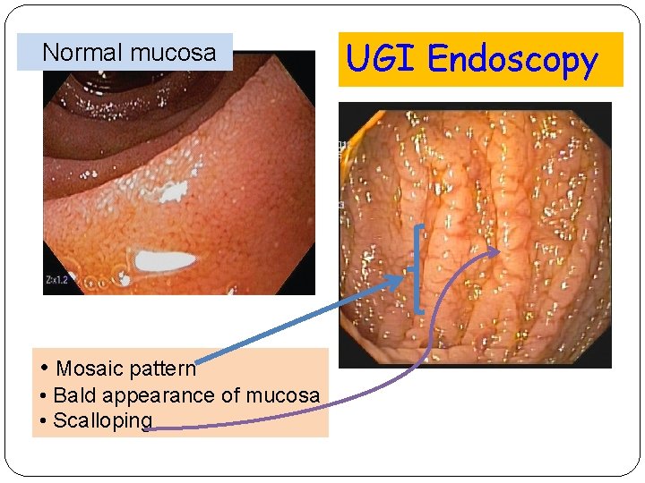Normal mucosa • Mosaic pattern • Bald appearance of mucosa • Scalloping UGI Endoscopy