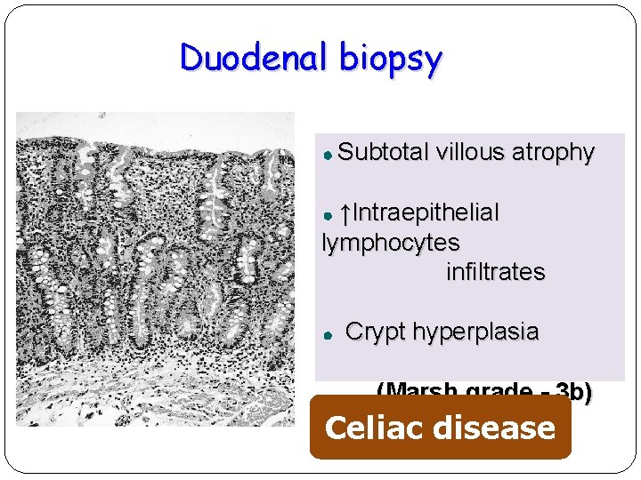 Duodenal biopsy Subtotal villous atrophy ↑Intraepithelial lymphocytes infiltrates Crypt hyperplasia (Marsh grade - 3