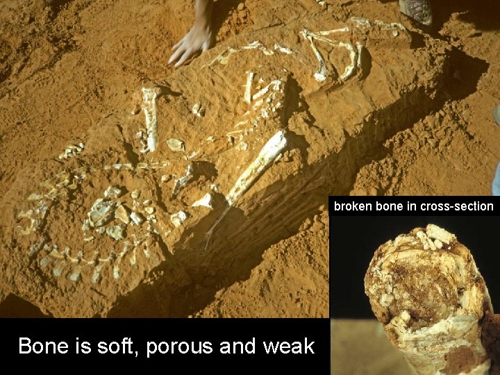 broken bone in cross-section Bone is soft, porous and weak 