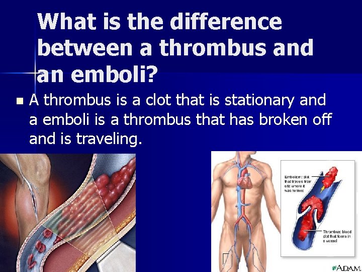 What is the difference between a thrombus and an emboli? n A thrombus is