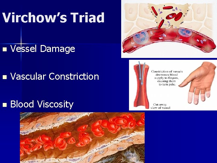 Virchow’s Triad n Vessel Damage n Vascular Constriction n Blood Viscosity 