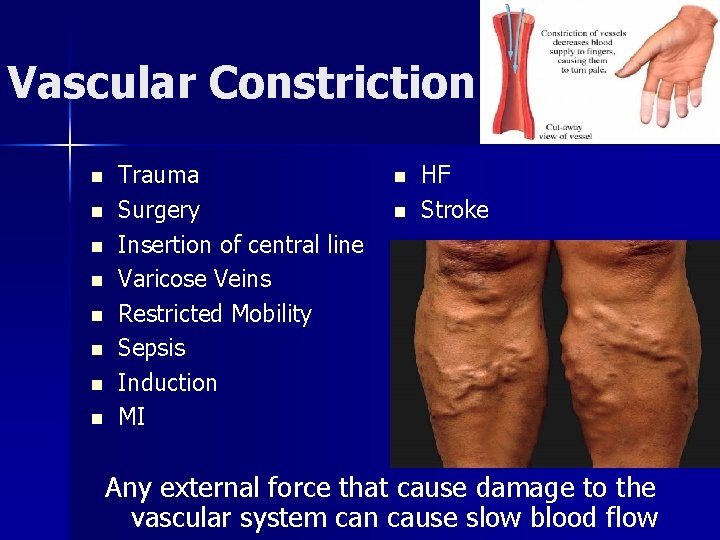 Vascular Constriction n n n n Trauma Surgery Insertion of central line Varicose Veins