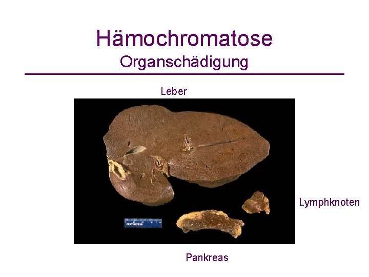 Hämochromatose Organschädigung Leber Lymphknoten Pankreas 