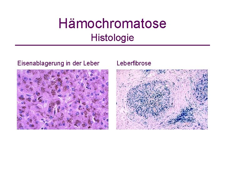 Hämochromatose Histologie Eisenablagerung in der Leberfibrose 