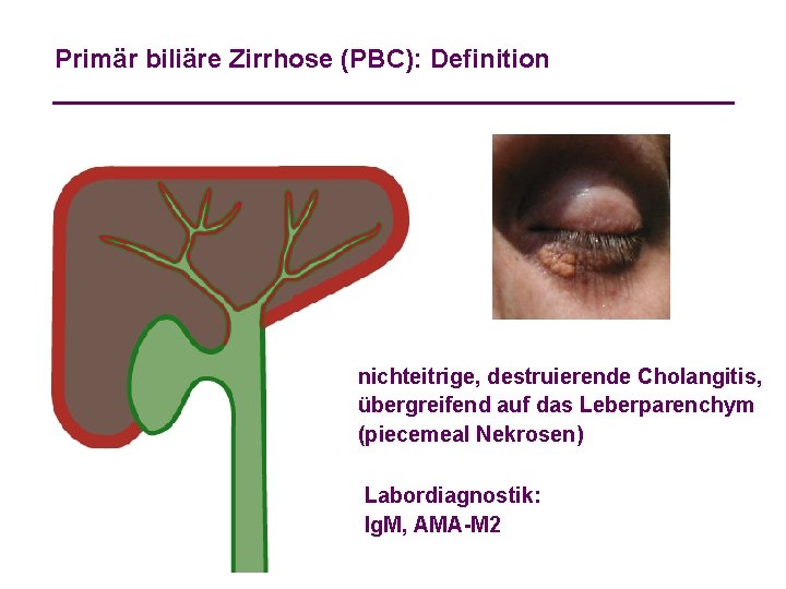 Primär biliäre Zirrhose (PBC): Definition nichteitrige, destruierende Cholangitis, übergreifend auf das Leberparenchym (piecemeal Nekrosen)