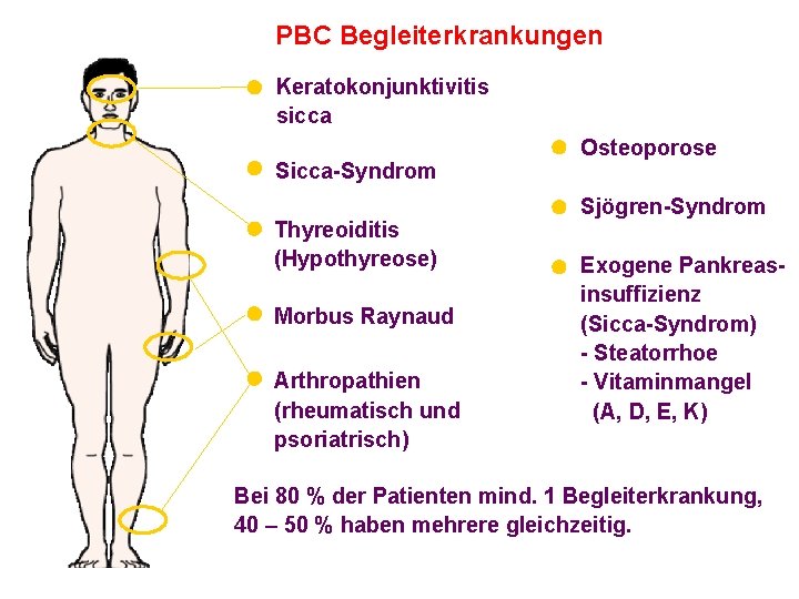 PBC Begleiterkrankungen Keratokonjunktivitis sicca Sicca-Syndrom Thyreoiditis (Hypothyreose) Morbus Raynaud Arthropathien (rheumatisch und psoriatrisch) Osteoporose