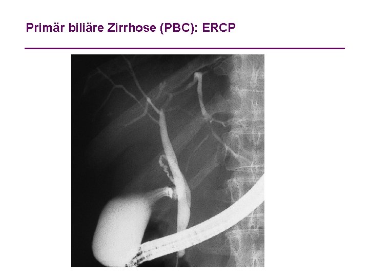 Primär biliäre Zirrhose (PBC): ERCP 