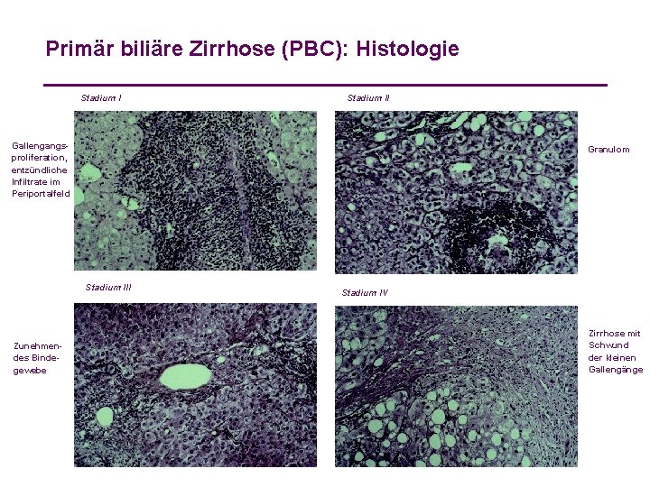 Primär biliäre Zirrhose (PBC): Histologie Stadium II Gallengangsproliferation, entzündliche Infiltrate im Periportalfeld Granulom Stadium