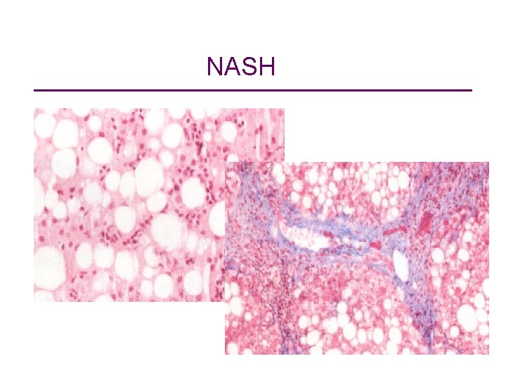 NASH 