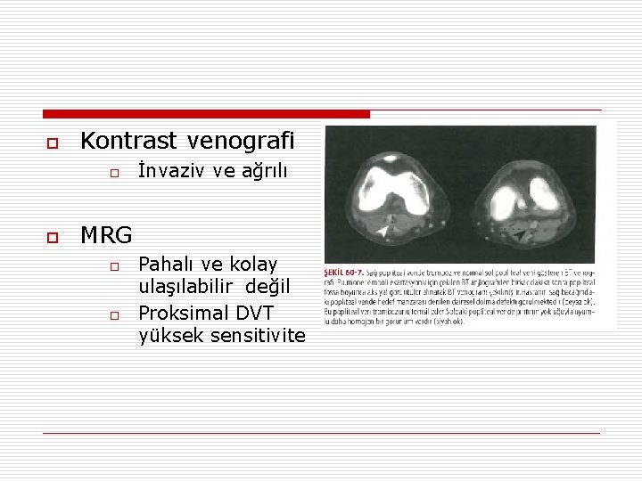 o Kontrast venografi o o İnvaziv ve ağrılı MRG o o Pahalı ve kolay