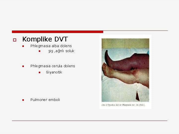 o Komplike DVT n n Phlegmasia alba dolens n şiş , ağrılı soluk Phlegmasia