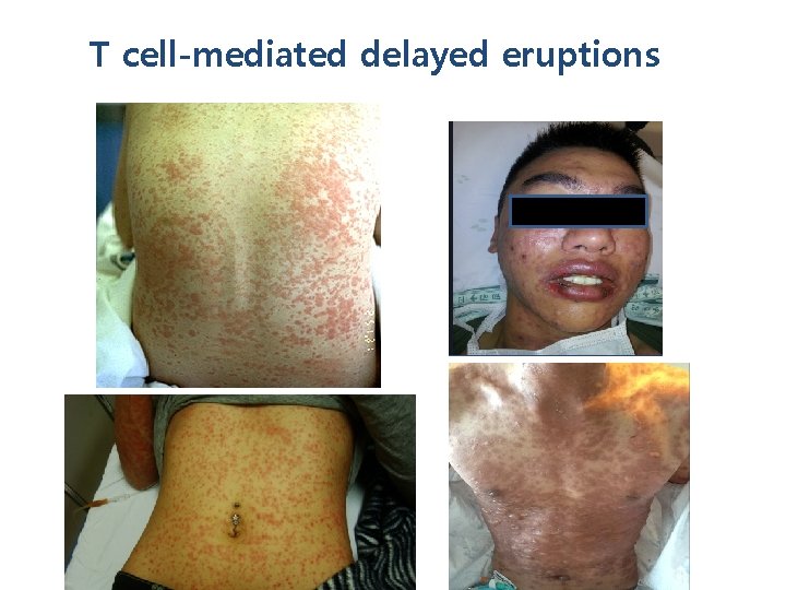 T cell-mediated delayed eruptions 