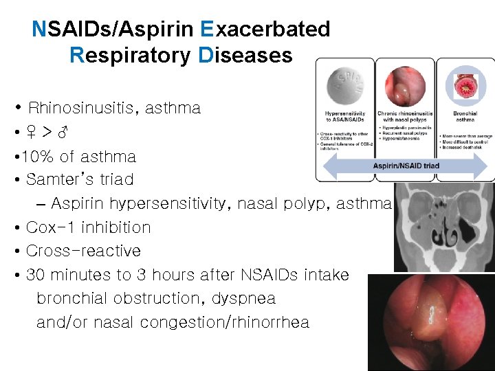NSAIDs/Aspirin Exacerbated Respiratory Diseases • Rhinosinusitis, asthma • ♀>♂ • 10% of asthma •