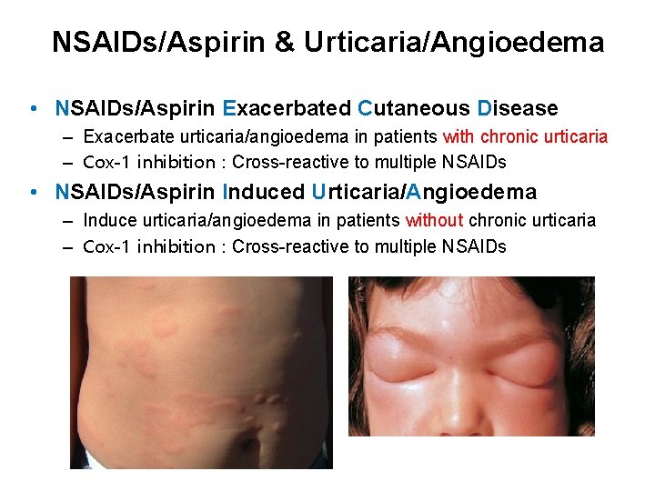 NSAIDs/Aspirin & Urticaria/Angioedema • NSAIDs/Aspirin Exacerbated Cutaneous Disease – Exacerbate urticaria/angioedema in patients with